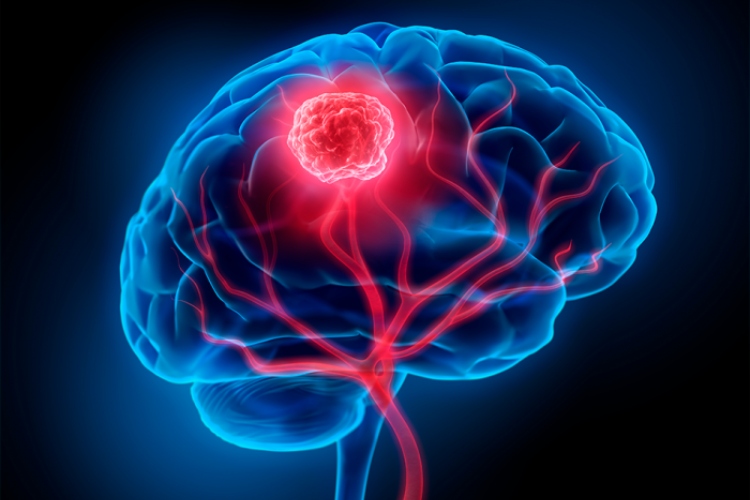 Niño de 13 años en Francia logra curarse de un cáncer cerebral mortal