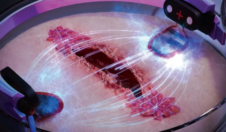 Estimulación eléctrica acelera la curación de heridas, revela estudio