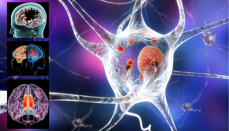 Nanoflores metálicas: el nuevo avance que promete tratar el Parkinson y el Alzheimer