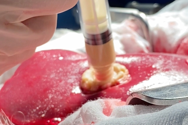 Adolescente crea gel de algas que detiene hemorragias