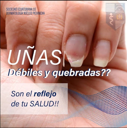Cuando una persona tiene dermatitis en las manos las uñas son muy delgadas y frágiles