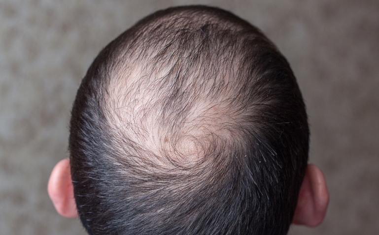 Alopecia: ¿a qué edad aparece y cómo prevenirla?Meta descripción: La alopecia puede aparecer