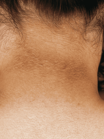 Acantosis nigricans: ¿Qué significan las manchas negras en el cuello?