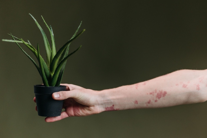 Dermatitis Atópica y salud mental: un círculo que puede intensificarse después de una emergencia