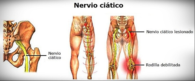De que depende que en algunas personas se pronuncie el nervio ciático